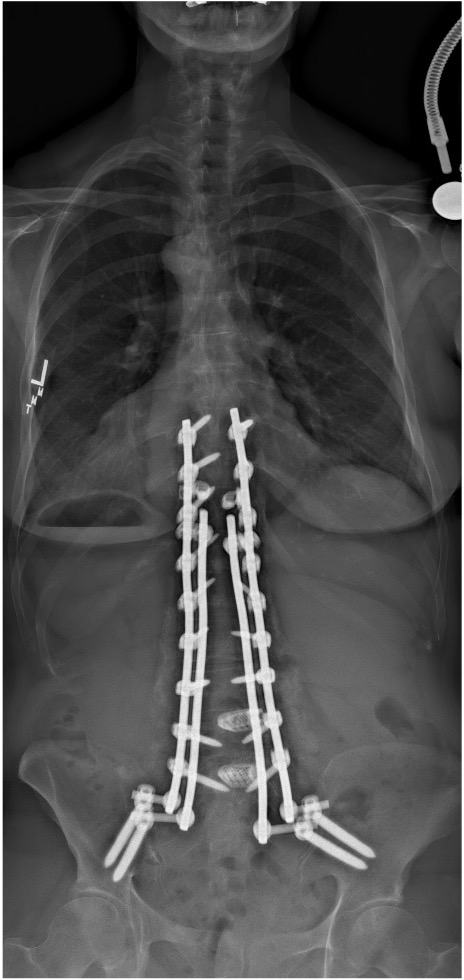 Following surgical deformity correction