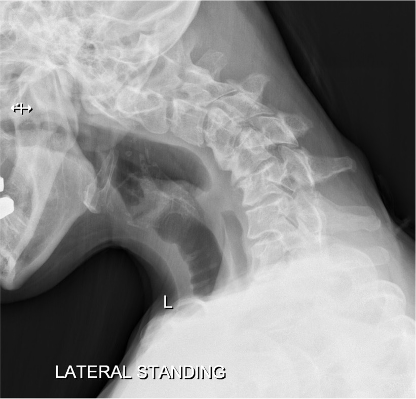 Cervical kyphosis