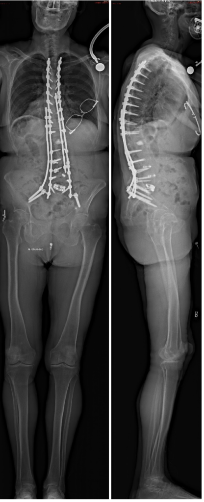 After surgical correction