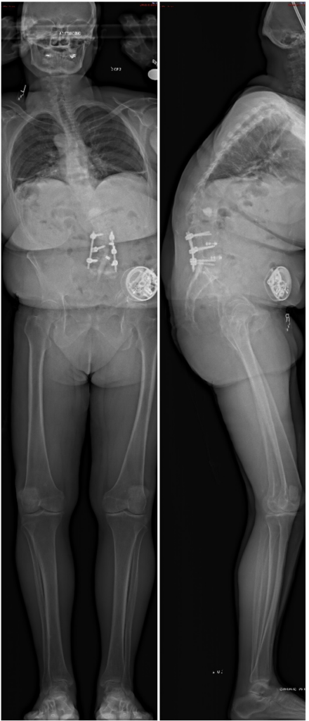 Pre-op sagittal imbalance