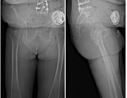 Pre-op sagittal imbalance