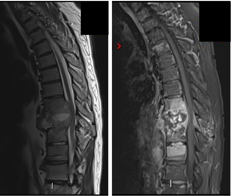 Thoracic tumor with severe spinal cord compression 